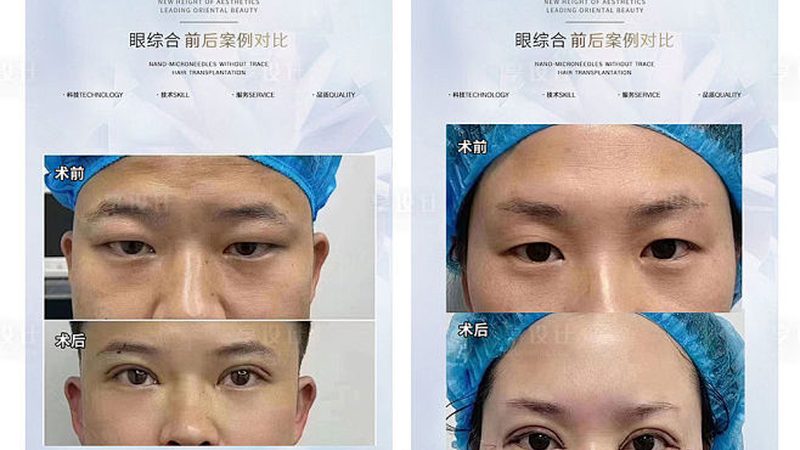 揭秘水光针：成分大揭秘，功效对比解析