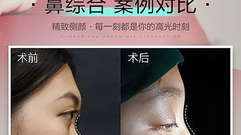 祛斑与光子嫩肤：揭秘两者之间的本质区别