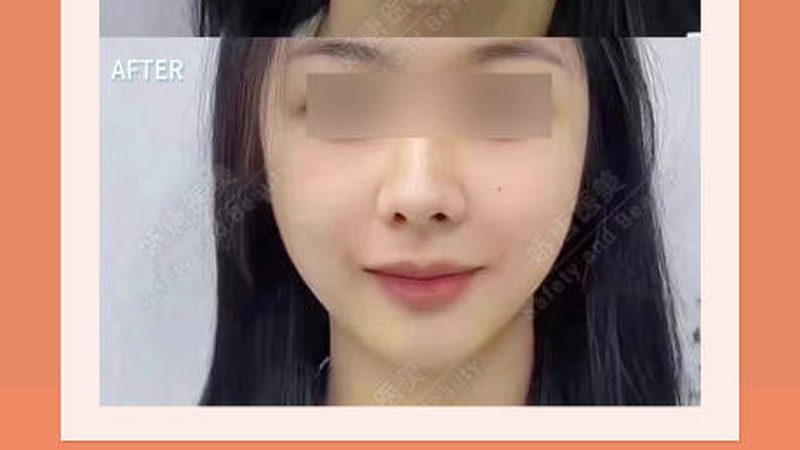 鼻综合整形，价格透明背后的秘密
