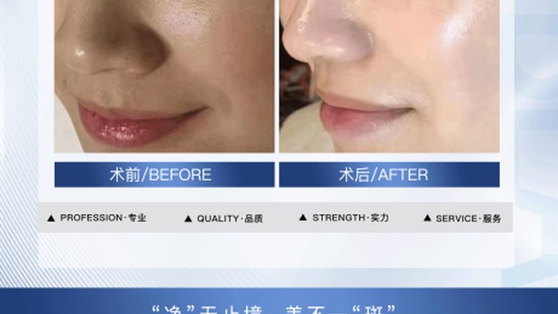 家用热玛吉美容仪：揭秘价格背后的科技与价值**