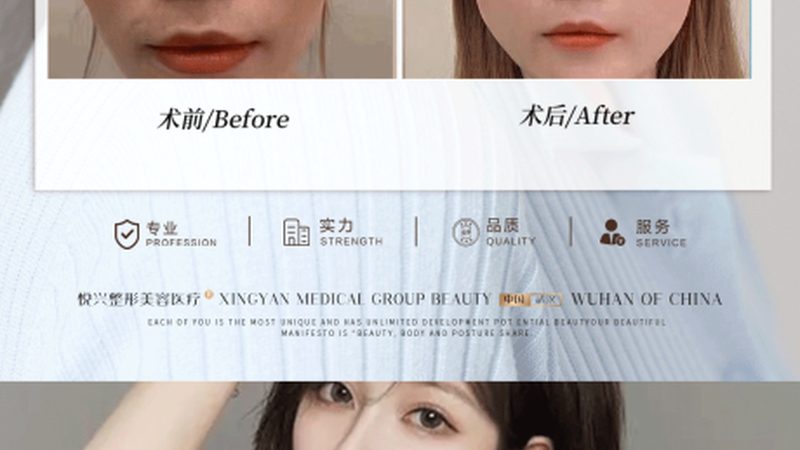 肋软骨隆鼻：揭秘其适应症与操作要点**