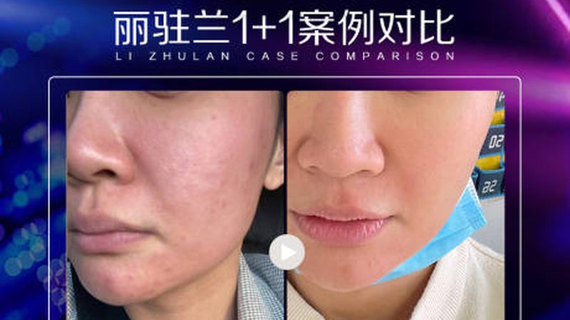 光子嫩肤美容仪器：揭秘价格背后的技术秘密
